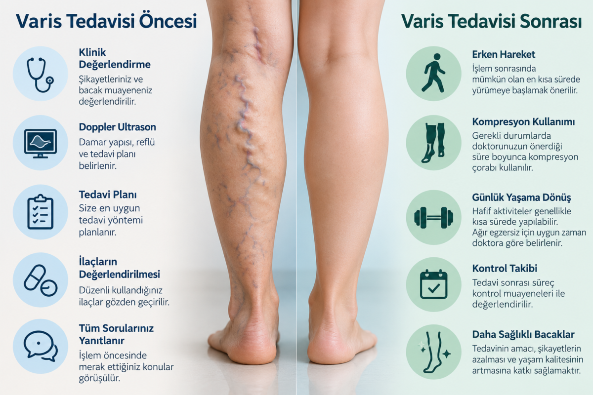 Varis tedavisi öncesi klinik değerlendirme, Doppler ultrason ve tedavi planı ile tedavi sonrası hareket, kompresyon ve kontrol sürecini gösteren tıbbi görsel