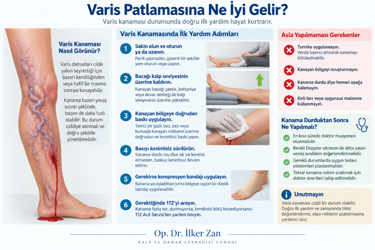 Varis patlamasına ne iyi gelir? Varis kanaması durumunda bacağı yükseltme ve doğrudan baskı uygulama