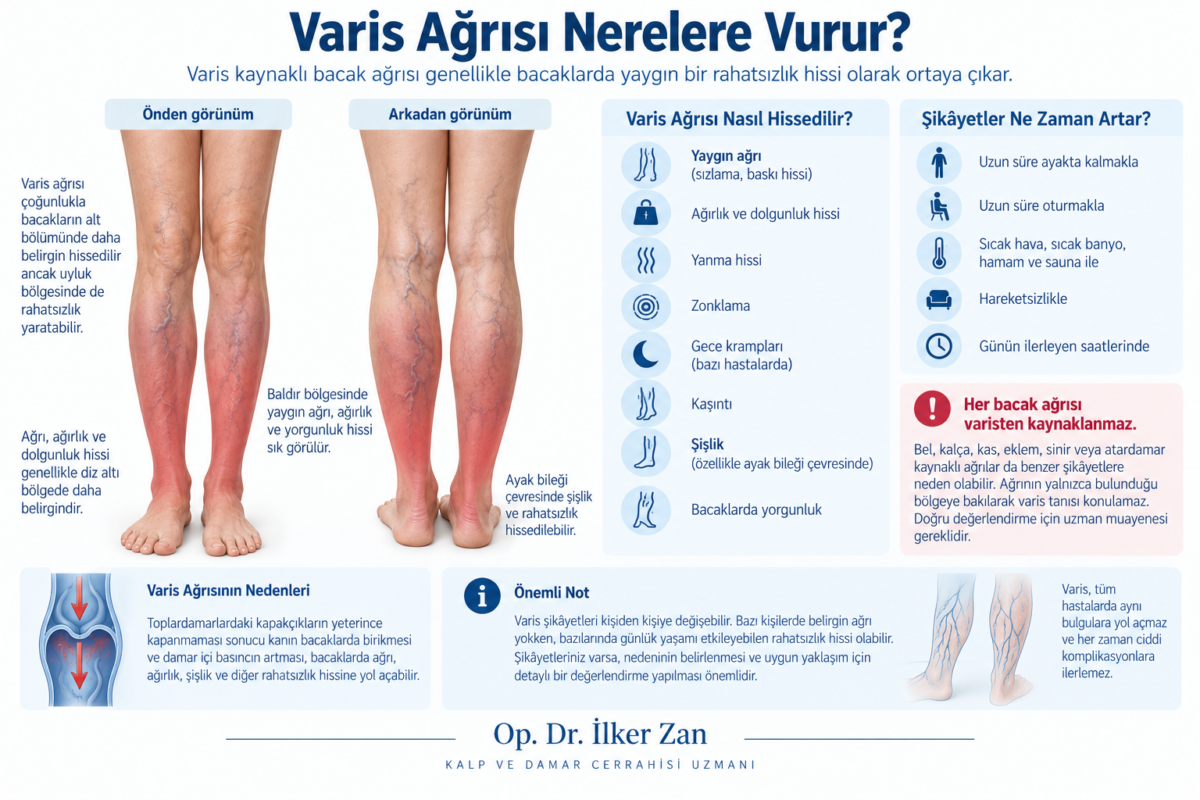 Varis ağrısının bacaklarda yaygın olarak hissedilmesini ve eşlik eden bacak şikâyetlerini gösteren tıbbi görsel
