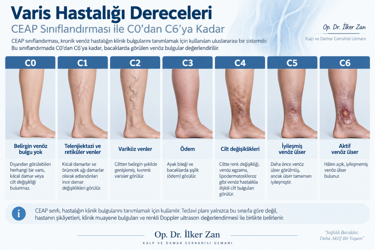 Varis hastalığı derecelerini gösteren CEAP C0-C6 sınıflandırması