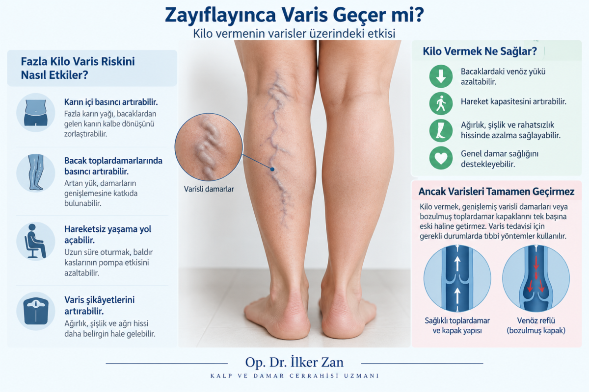 Zayıflayınca varis geçer mi? Kilo vermenin varis şikâyetleri ve venöz dolaşım üzerindeki etkisini gösteren tıbbi görsel
