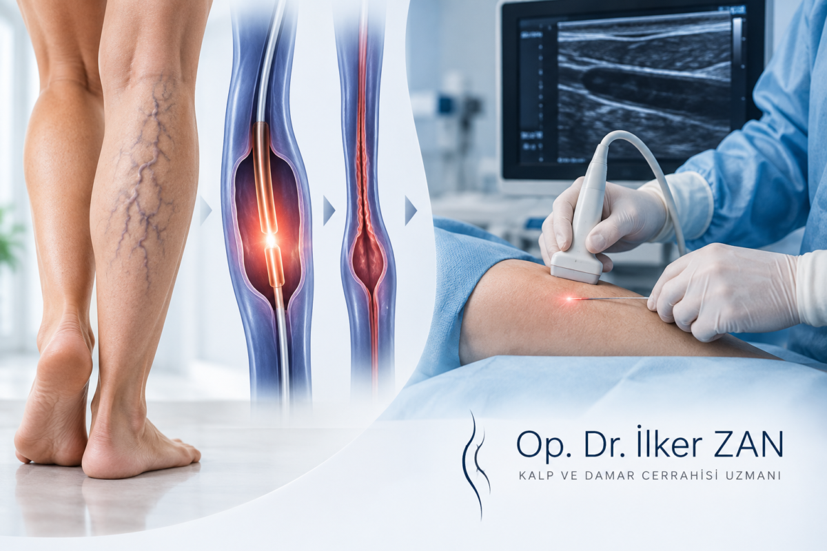 Endovenöz lazer ve radyofrekans ablasyon (RFA) ile varis tedavisini ve renkli Doppler eşliğinde damar değerlendirmesini gösteren tıbbi görsel