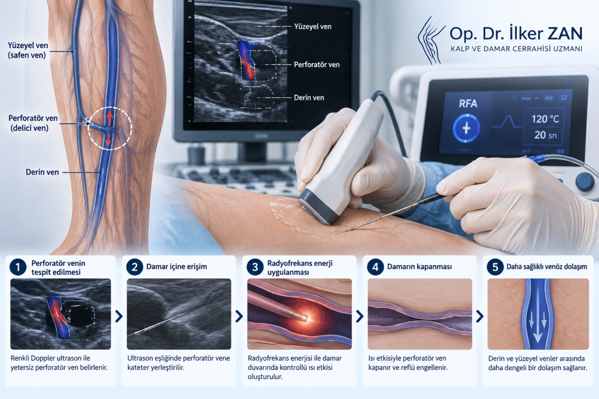 Perforan ven yetmezliğinde renkli Doppler ultrason eşliğinde radyofrekans ablasyon tedavisini gösteren tıbbi görsel