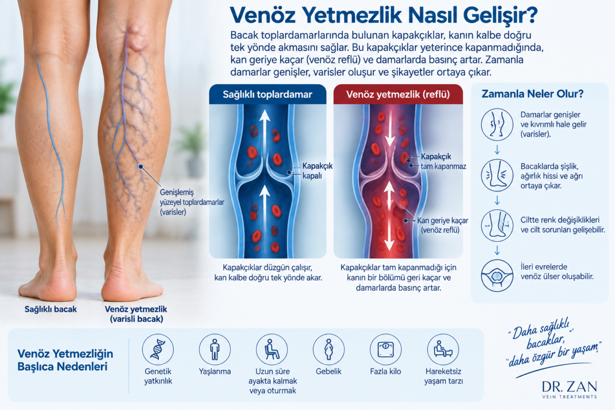 Venöz yetmezlikte toplardamar kapakçıklarının çalışması ve venöz reflü