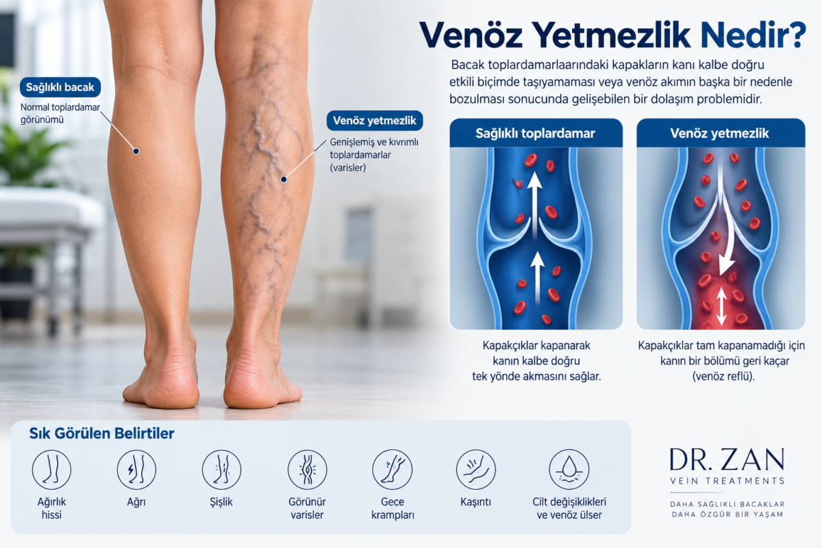 Venöz yetmezlik tanısı ve tedavisi için renkli Doppler ultrason ve tedavi seçenekleri